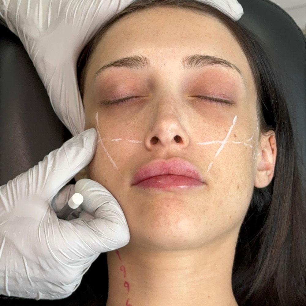 Sesi suntik filler Juvederm